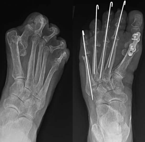 Inter-Positional Reconstruction - Arthroplasty Types