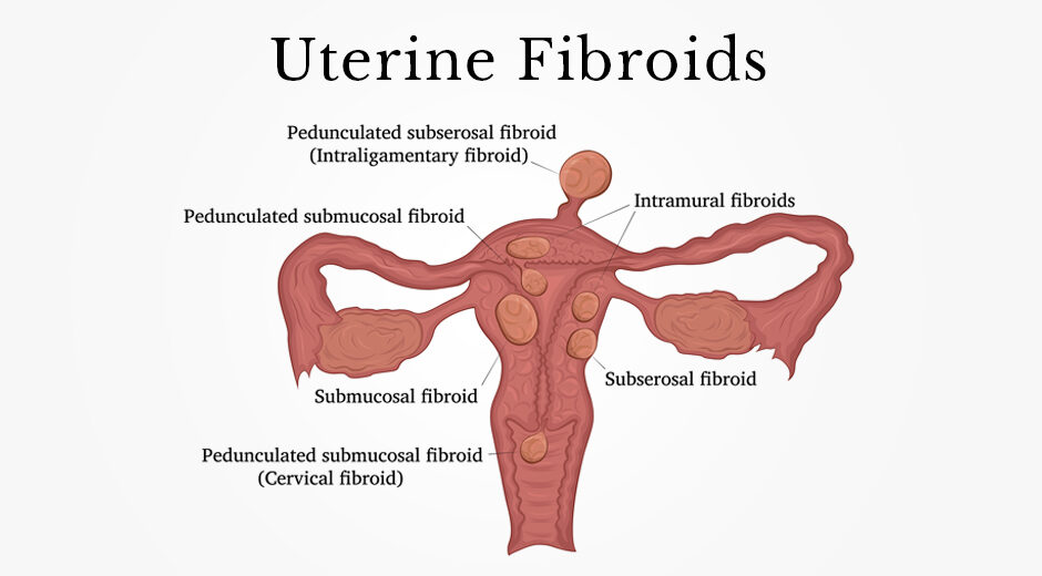 Best Treatment For Uterine Fibroids in Mumbai-Dr Ranjana Dhanu