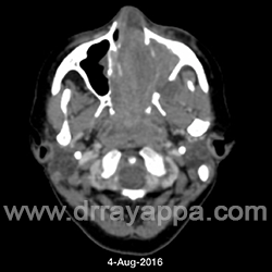 Sinonasal Teratocarcinoma - Endoscopic Resection + VIDEO