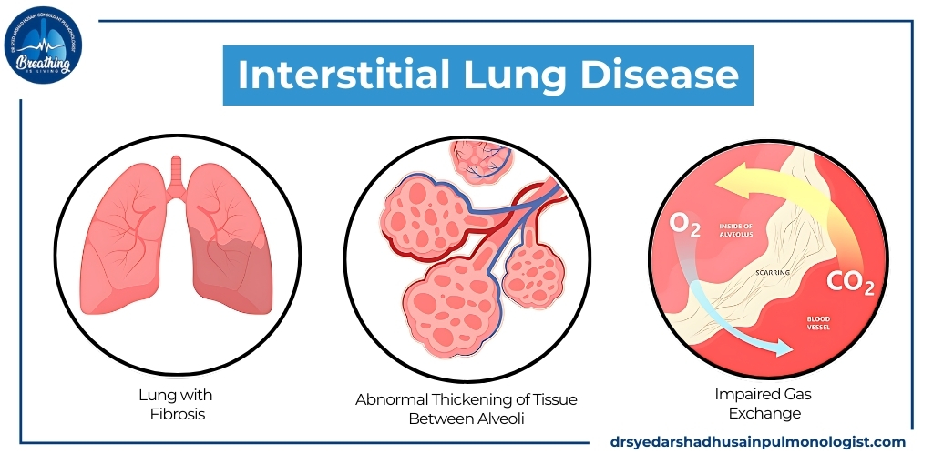 Interstitial Lung Disease: Symptoms, Treatment and Prevention