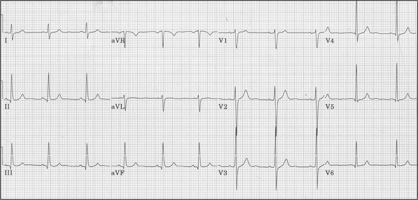 ECG Library #6095