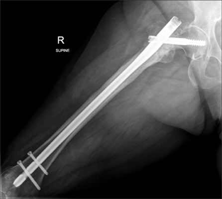 Breakage of a Lag Screw of Cephalomedullary Nail: A Technique of Removal