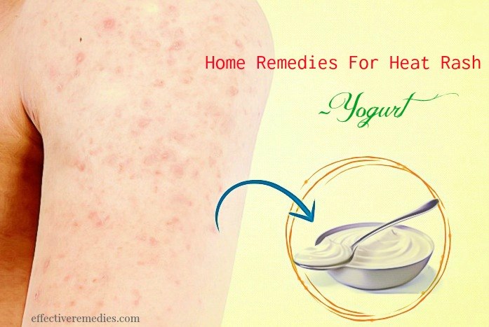 home remedies for heat rash - yogurt