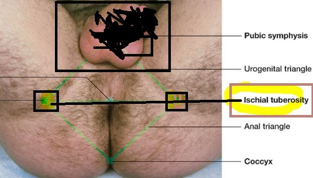 Ischial tuberosity position pain