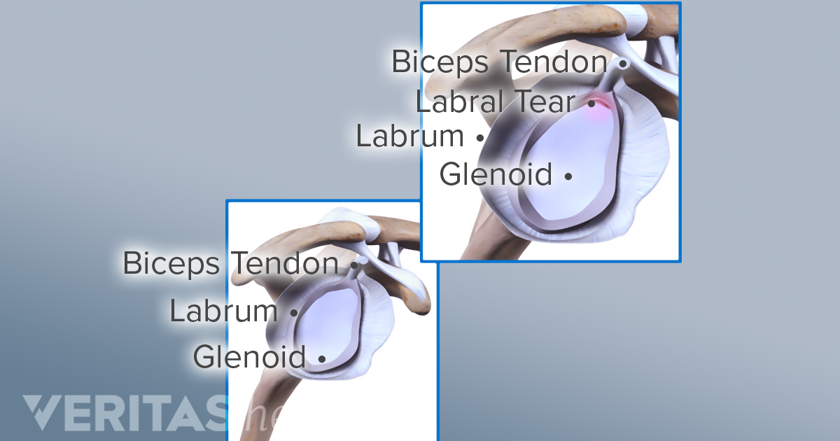 SLAP Tear Causes and Risk Factors