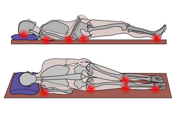 Pressure Ulcer Positioning