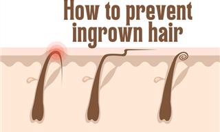 Health Tip: How to Prevent Ingrown Hair