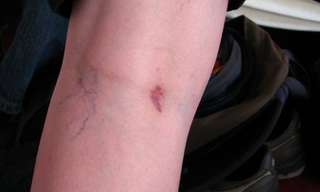 Natural Ways of Treating Spider Veins