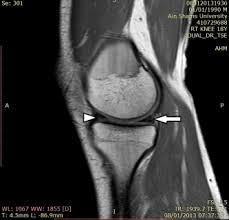 The journal of musculoskeletal medicine. Mri In Assessment Of Sports Related Knee Injuries Sciencedirect