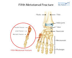 There has been conflicting literature on management of fifth metatarsal fractures this article provides a thorough review of fifth metatarsal fractures with examination of relevant literature to describe the management of fifth. Fifth Metatarsal Fracture Rehab My Patient