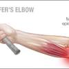 Click here for an exhaustive medical article on forearm and elbow pain. 1