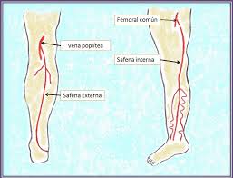 Produce dolor pero no hay riesgo de embolia pulmonar. Chuleta Tromboflebitis Superficial Y Profunda De Extremidades Inferiores Mis Chuletas Medicas