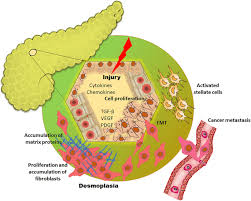 Elevated fibrinogen increases the risk of thrombosis and is also associated with increased invasiveness, metastasis, and poor clinical outcome. Tumor Stromal Crosstalk In Pancreatic Cancer And Tissue Fibrosis Molecular Cancer Full Text