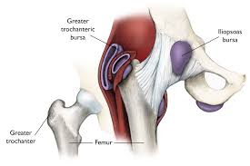 The psoas major muscle (usually shortened to just the psoas muscle) is one of the muscles of the posterior abdominal wall and lies not in the retroperitoneum but posterior to it, in the iliopsoas compartment. Hip Bursitis Orthoinfo Aaos