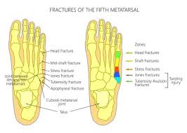 This chapter describes a surgical technique for intramedullary. Jones Fracture A Common Foot Injury In Sports Kansas City Foot Ankle