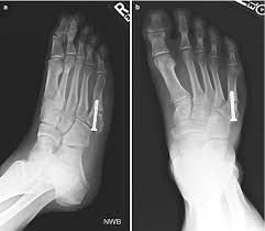 Sudden cutting motion see fifth metatarsal fracture for absolute referral indications. Revision Surgery For 5th Metatarsal Fractures Springerlink