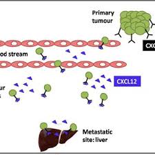 Ascites unfortunately, most pancreatic cancers are found after the cancer has grown or progressed beyond the pancreas or has metastasized to other places. Pdf Pancreatic Cancer Current Concepts In Invasion And Metastasis