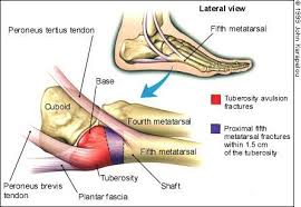 Management of distal radius fractures programme. 5th Metatarsal Injuries Back In Action