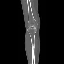 Learn anatomy using a full pacs! Normal Ct Knee Radiology Case Radiopaedia Org