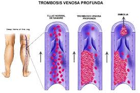 Si bien ambas pueden tener un grado de complejidad leve, pueden llegar a causar la muerte del paciente. Trombosis Venosa Dr Cristian Anez Martinez