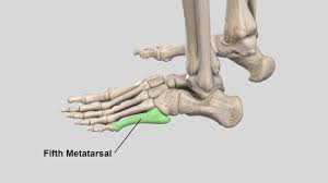 Without manipulation, each $ 275.85. Surgical Management Of Fifth Metatarsal Jones Fractures Intramedullary Screw Fixation Youtube