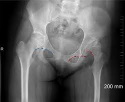 In utero fetal hips lie typically in flexion, abduction and external rotation, with the left hip usually muscular anatomy. Assessment Of The Young Adult Hip Joint Using Plain Radiographs Springerlink