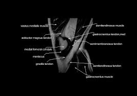 Properly performed and interpreted, mri not only contributes to diagnosis but also serves as an important guide to treatment planning and. Mri Knee Anatomy Knee Sagittal Anatomy Free Cross Sectional Anatomy