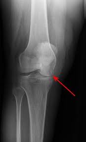 Mri for evaluating knee pain in older patients: Osteonecrosis Of The Knee Orthoinfo Aaos