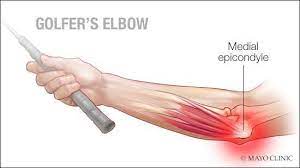 Golfer's elbow is a type of an injury that happens on the inner tendons of the elbow causing pain on the inner side of the elbow and hand. Medial Epicondylitis A K A Golfer S Elbow Orthopedic Center For Sports Medicine Sports Medicine Physicians