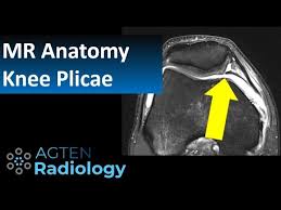 This webpage presents the anatomical structures found on knee mri. Mri Anatomy Of Knee Plicae Youtube