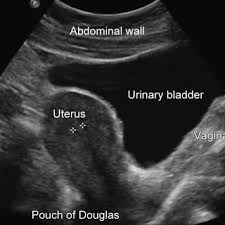 Normal female pelvic ultrasound images. Pdf Pelvic Ultrasound Simulation Training Models And Case Scenarios