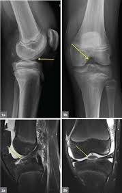 Master leg and knee anatomy using our topic page. 15 Year Old Boy With History Of Knee Pain