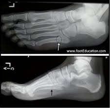 Fractures of the proximal fifth metatarsal: Metatarsal Fractures Orthopaedia