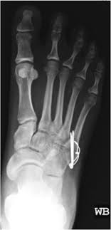 5th metatarsal base fractures are common traumatic fractures among athletic populations that are notorious for nonunion due to tenuous blood supply. Conservative Versus Surgical Management Of Fifth Metatarsal Avulsion Fractures Sciencedirect