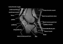 In the knee mri mastery courses, we give you everything you need in order to evaluate this joint. Mri Knee Anatomy Knee Sagittal Anatomy Free Cross Sectional Anatomy