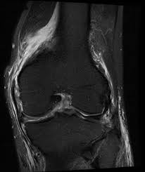 In the two most recent series, meniscus mri and mri of the supporting structures, we focus on two knee mri anatomy & diganoses covered in this course. Medial Supporting Structures Of The Knee With Emphasis On The Medial Collateral Ligament Radsource