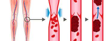 Trombosis venosa superficial, la aparición de síntomas como fiebre alta y secreción purulenta sugiere la presencia de infección sobreagregada, comúnmente relacionado al uso de catéteres intravenosos. La Trombosis Venosa Superficial Causas Y Tratamiento Canalsalud