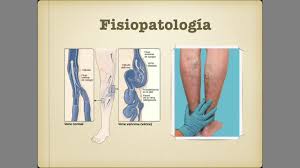 Diferencias entre trombosis venosa profunda y trombosis venosa superficial. Trombosis Venosa Profunda Youtube