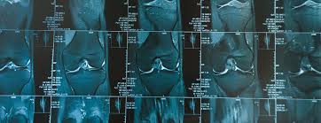 Mr arthrogram knee loose osteochondral lesion. Knee Mri Scan