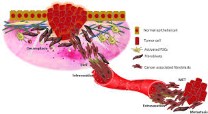 One thing to consider is your quality of life and palliative care options. Tumor Stromal Crosstalk In Pancreatic Cancer And Tissue Fibrosis Molecular Cancer Full Text