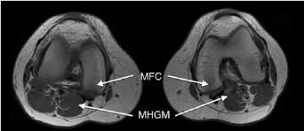 In relation to the pcl, the ligament of humphrey courses anterior, and the ligament of wrisberg courses posterior. Axial Mri Images Of The Popliteal Region Of The Knee The Medial Head Download Scientific Diagram