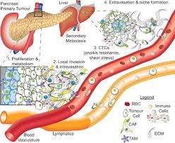 Cancer metastatic to the pancreas from other primary sites is uncommon, and it has been treated with an aggressive surgical approach in fit patients when the primary tumor is the pancreas can however be the site of metastasis from renal cell cancer, lung, colon and breast cancers. Combating Pancreatic Cancer With Pi3k Pathway Inhibitors In The Era Of Personalised Medicine Gut