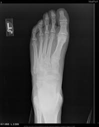 J am acad orthop surg. Medpix Case Avulsion Fracture Of The Base Of The Fifth Metatarsal