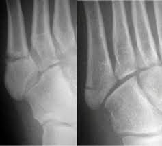 Treatment of fifth metatarsal fractures depends on the zone of injury. Fractures Of The 5th Metatarsal Bone Injuries Poisoning Msd Manual Professional Edition