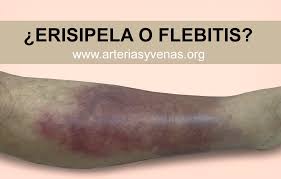 Los trombos venosos superficiales rara vez causan complicaciones graves y en. Erisipela O Flebitis Arterias Y Venas