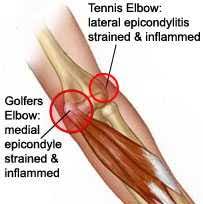 This type of pain can occur as a result of an acute injury or it can develop gradually from overuse of the elbow joint. Toggle Navigation Home What We Do Balance Exercises Core Stability Swiss Ball Clinical Reasoning Dry Needling Fascial Manipulation Manual Therapy Muscle Energy Techniques Nutritional Supplementation Postural Correction Pilates Reformer