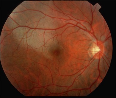 Traumatic Chorioretinopathies | Ento Key