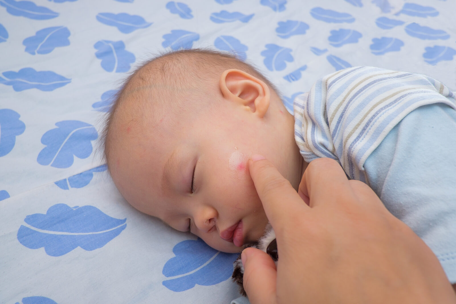 Bebé con alergia a las picaduras.