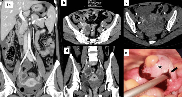 Posttraumatic Corpus Luteal Cyst Rupture: A Diagnostic Enigma for ...