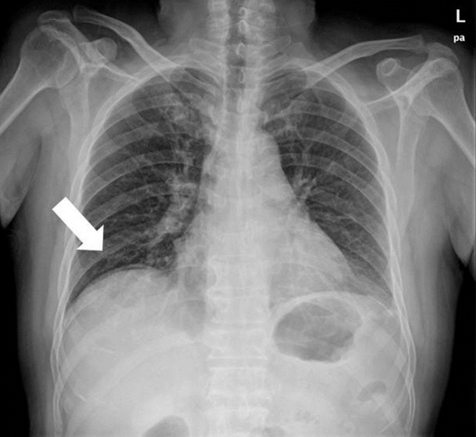 Acute peritonitis caused by a fibrosarcoma of the transverse colon in ...